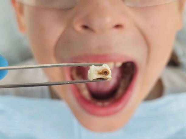 Best Emergency Dental Extractions in West Park, CA